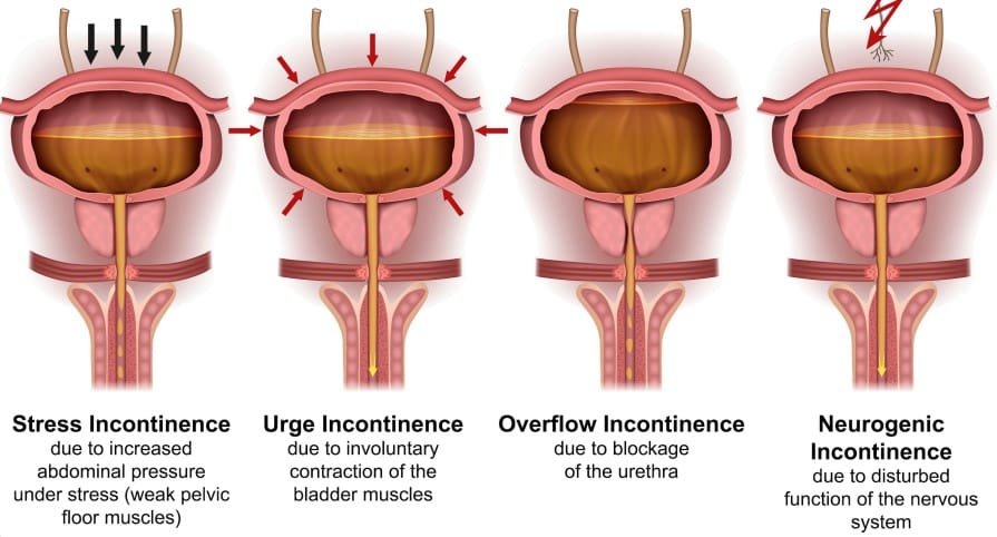 Medical diagram of the four types of urinary incontinence: stress, urge, overflow and neurogenic