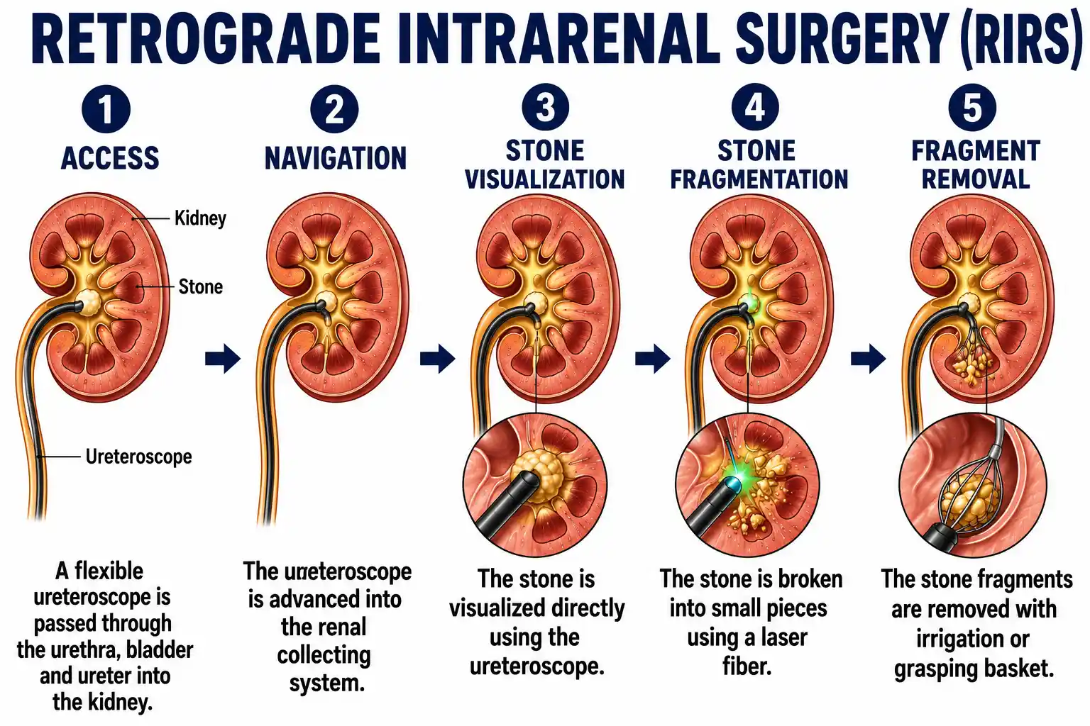 Medical diagram of Retrograde Intrarenal Surgery in five steps: access, navigation, stone visualization, laser fragmentation and fragment removal